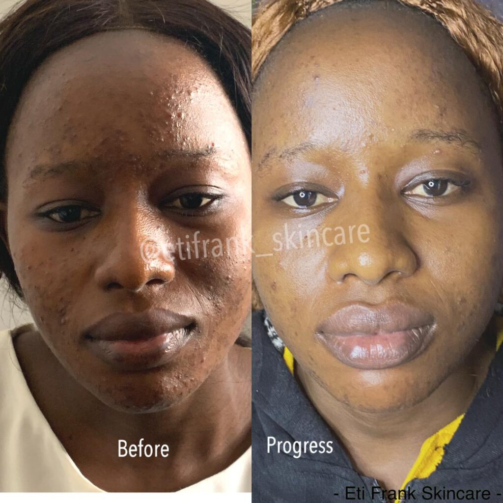 alt="Before and after 4-week Eti Skin acne routine"